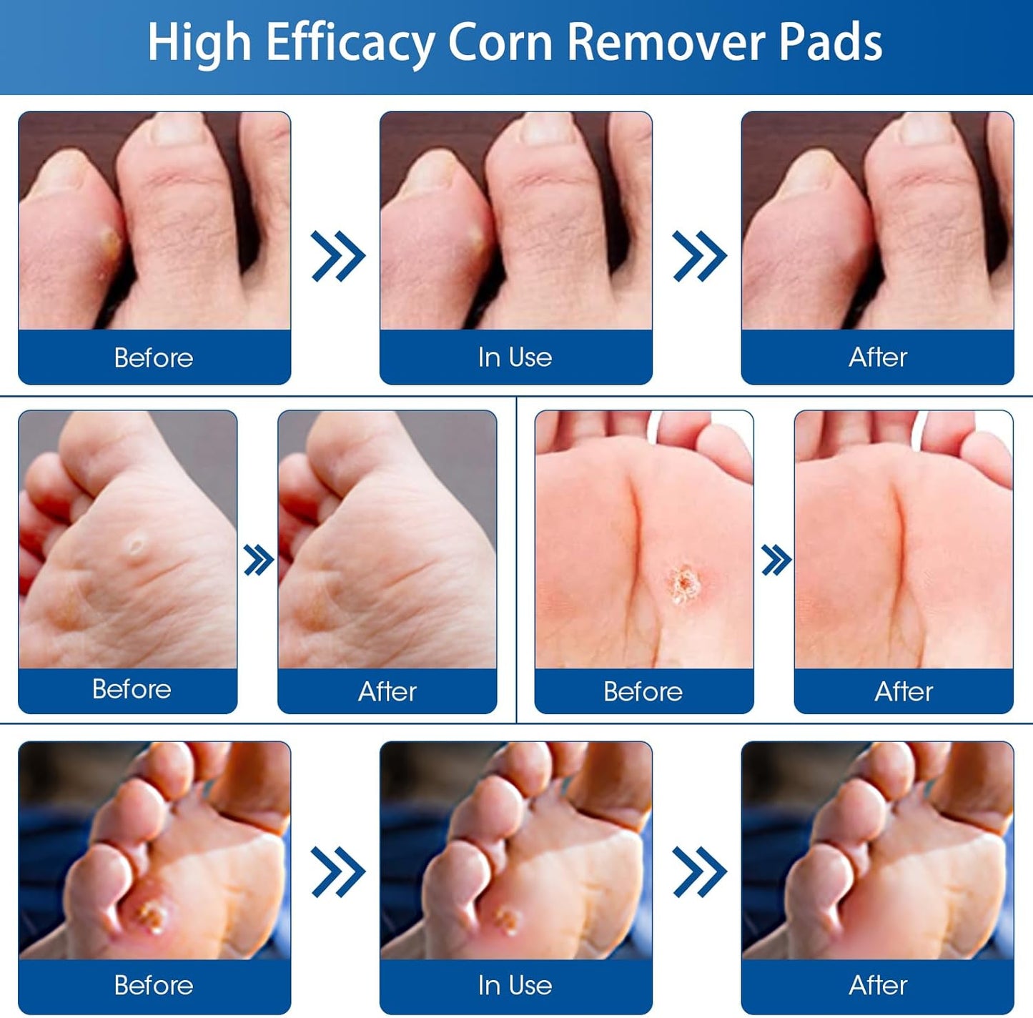 38 Count Corn Removal Pads for Feet and Toe, Corn Plasters Feet Remover for Feet Extra Strength, Callous Remover